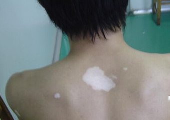 胳膊上的小白点是不是白癜风